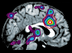 היפנוזה ושיכוך כאבים